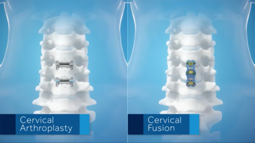 Range of Motion: Cervical Arthroplasty Compared to Cervical Fusion